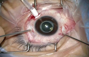 20-gauge pars plana vitrectomy in pseudophakic eye