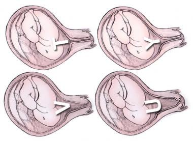 Stages of incompetent cervix. 