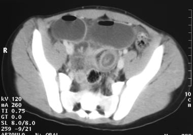 Preoperative CT scan of abdomen in 14-year-old chi