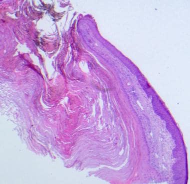 Pathology of cutaneous squamous cell carcinoma and