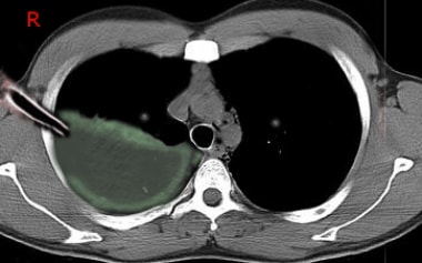 CT scan showing a large collection in the right ch