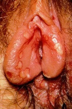 Genital herpetic infection. 