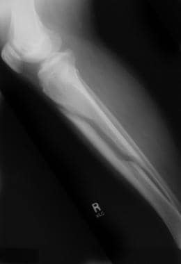 脊髓型骨质疏松患者的股骨