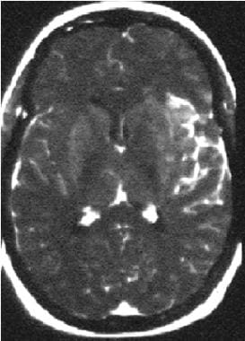 Axial T1-weighted postcontrast image obtained in a
