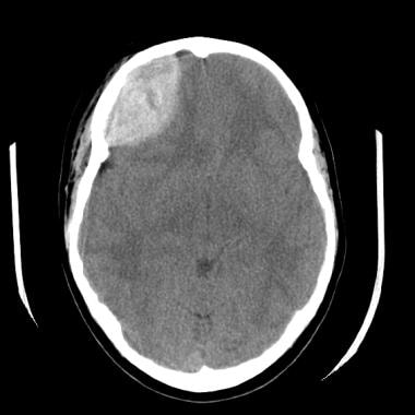 An epidural hematoma overlies the right frontal lo