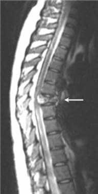 Magnetic resonance image of a thoracic spinal hema