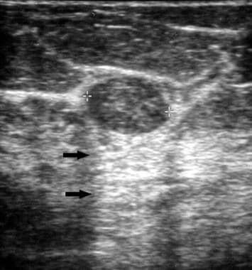 Ultrasonography in Breast Cancer: Overview, Role of Ultrasonography in ...