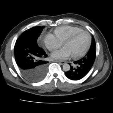 pericardial effusion x ray