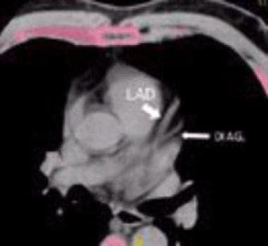 Coronary artery calcification - CT. Cross-sectiona