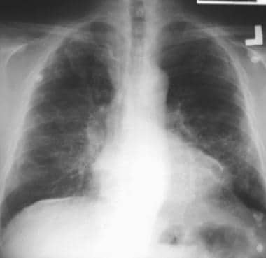 Case 1. Postero-anterior (PA) chest radiograph in 