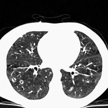 Chest CT in a patient with pulmonary eosinophilic 