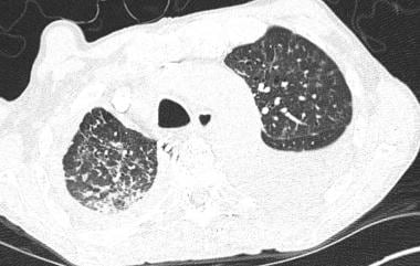 Axial high-resolution CT scan in another patient w