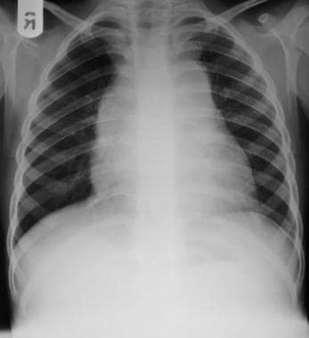 Differential diagnosis. Chest radiograph shows ext