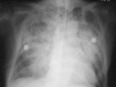 Anteroposterior chest radiograph shows interstitia