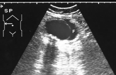 Axial ultrasonogram through the gallbladder shows 