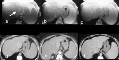 A 48-year-old male with cirrhosis from hepatitis C