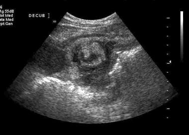 Ultrasound scan demonstrating intussuscepting ceca