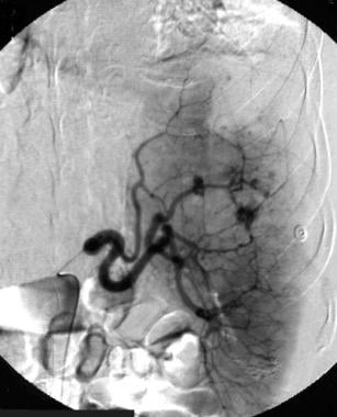 Spleen, trauma. Arteriogram obtained with a main s