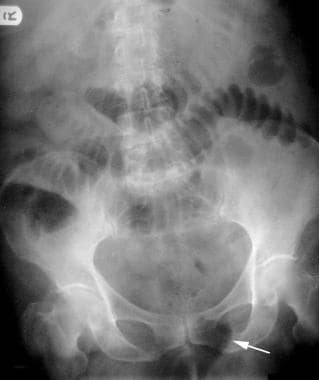 This plain abdominal radiograph of a 55-year-old w