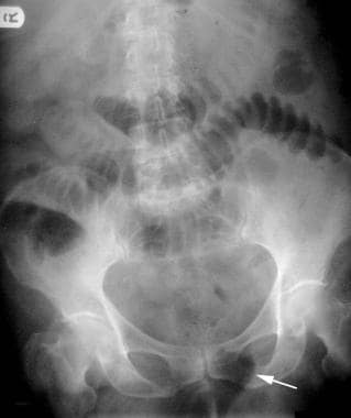 Abdominal X-ray with Gastrografin oral contrast media seen in the large