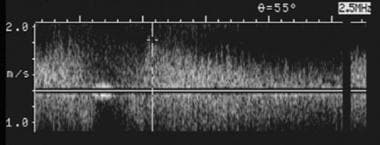 Spectral Doppler ultrasonogram of the portal vein 