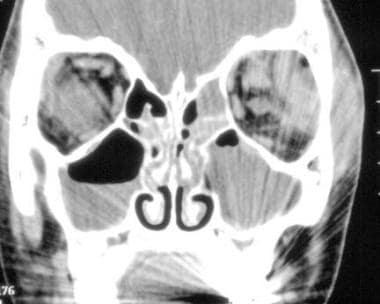 Coronal computed tomography scan in a pediatric pa
