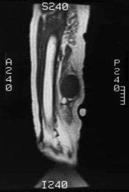 Noninfused T1-weighted MRI reveals a low signal in