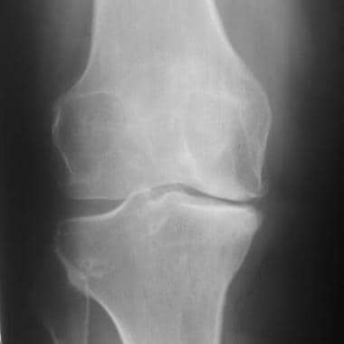 Radiograph of a nondisplaced transverse fracture o