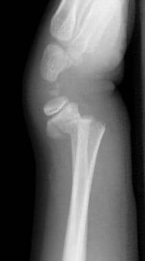 Lateral view of the wrist demonstrates a Colles fr