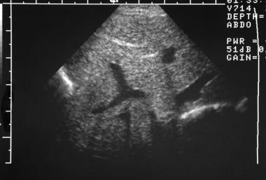 Ultrasonogram of a right-sided congenital diaphrag