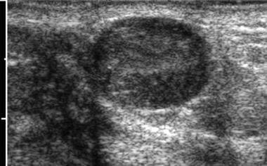 Ultrasonogram of fibroadenoma. Image courtesy of B
