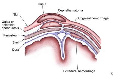 Birth Injuries Caused by Vacuum Extraction Complications