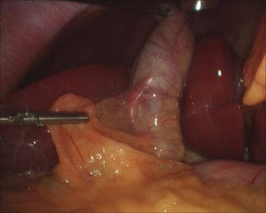 Laparoscopic cholecystectomy. Lateral grasper is u