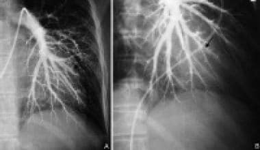 (A) Left pulmonary angiogram shows faint subsegmen