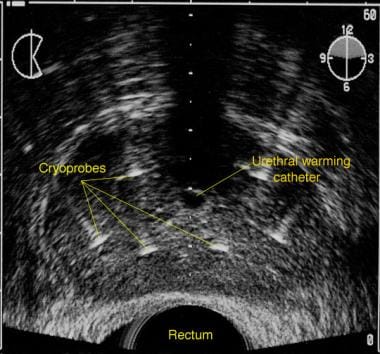 Transrectal sonogram of the prostate illustrating 