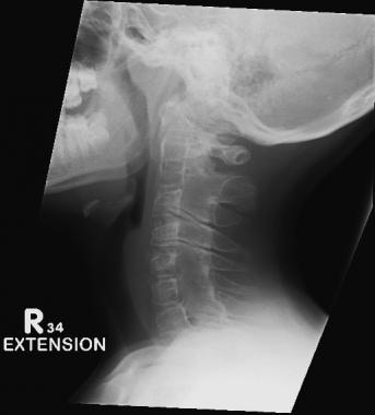 Ankylosis in the cervical spine at several levels 