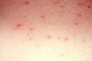 clindamycin side effects on skin