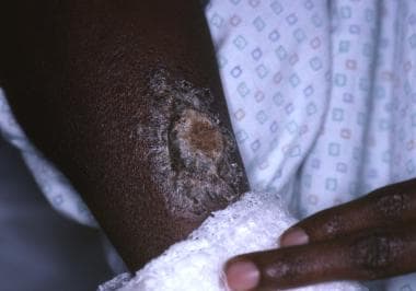 A 24-year-old woman with rapidly evolving pyoderma