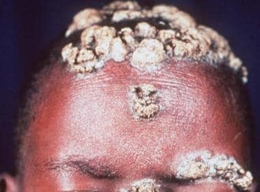 Chronic mucocutaneous deals candidiasis