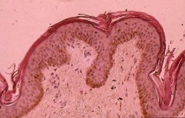 Pityriasis rotunda Seconda的经典组织学