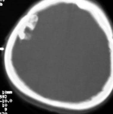 Case 1: Bone-window CT reveals calcification of th