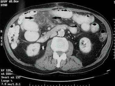 CT image of increased mesenteric tissue density or
