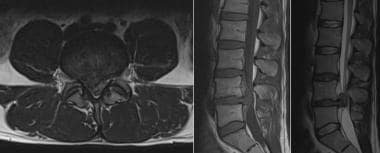 Progression of disk herniation. Axial T2 and sagit