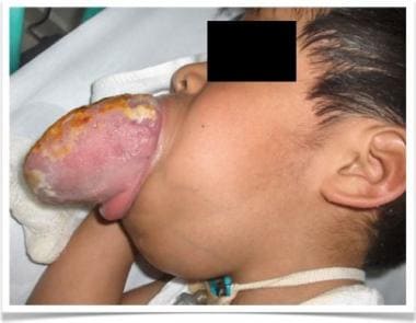 Clinical picture of 5-year-old boy with arterioven