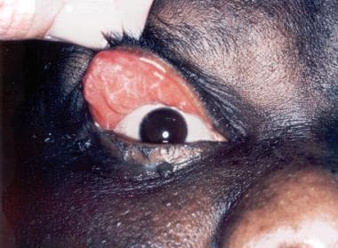 Floppy eyelid syndrome. Lax, rubbery upper eyelid 
