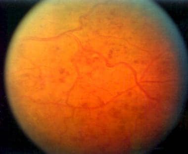 Scattered retinal hemorrhages in a patient with ce