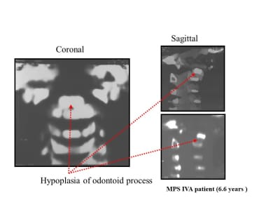 Mps Radiology Morquio Syndrome (Mucopolysaccharidosis Type IV) Clinical Presentation ...