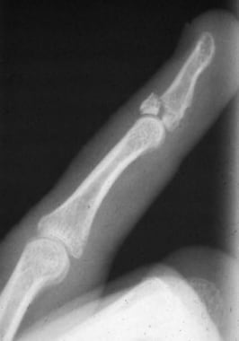 xray of broken finger