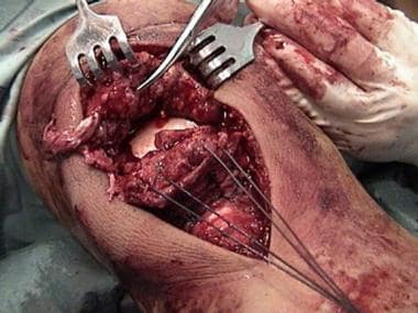 Patellar tendon rupture. The inferior pole of the 