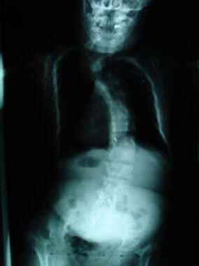 Scoliosis in a patient with diastrophic dysplasia.
